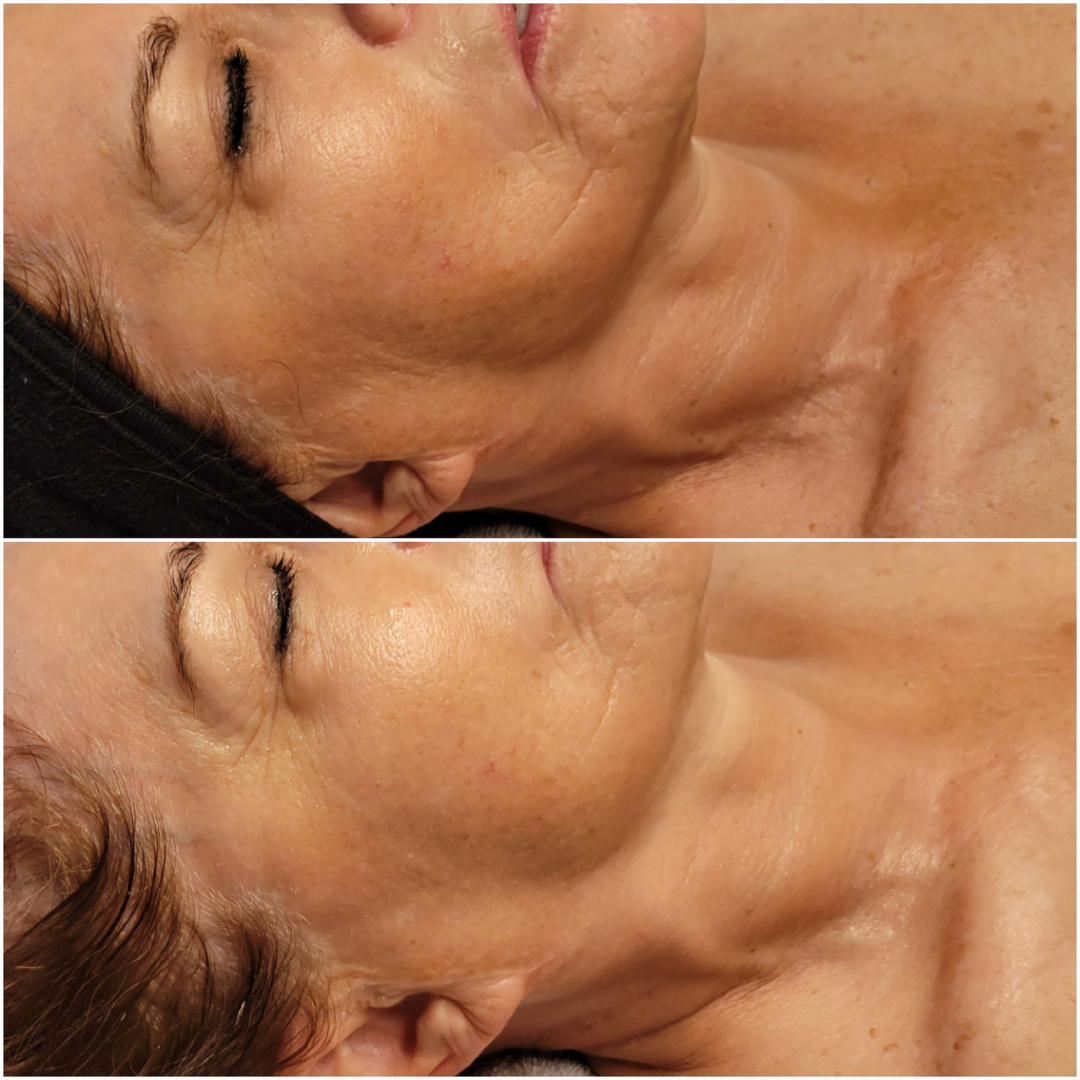 an image of a woman before and after an slow aging facial.